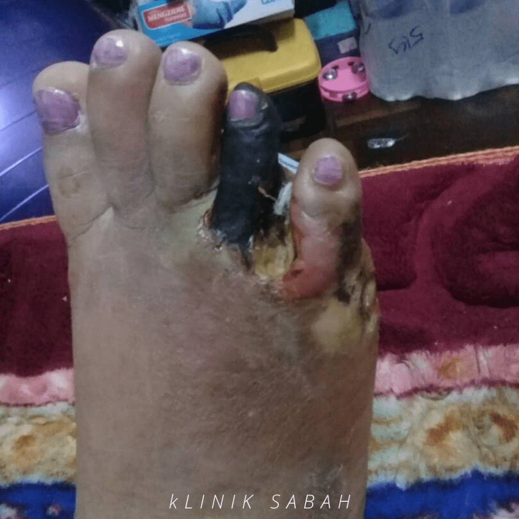 Jari kaki yang sudah hitam (gangrene)