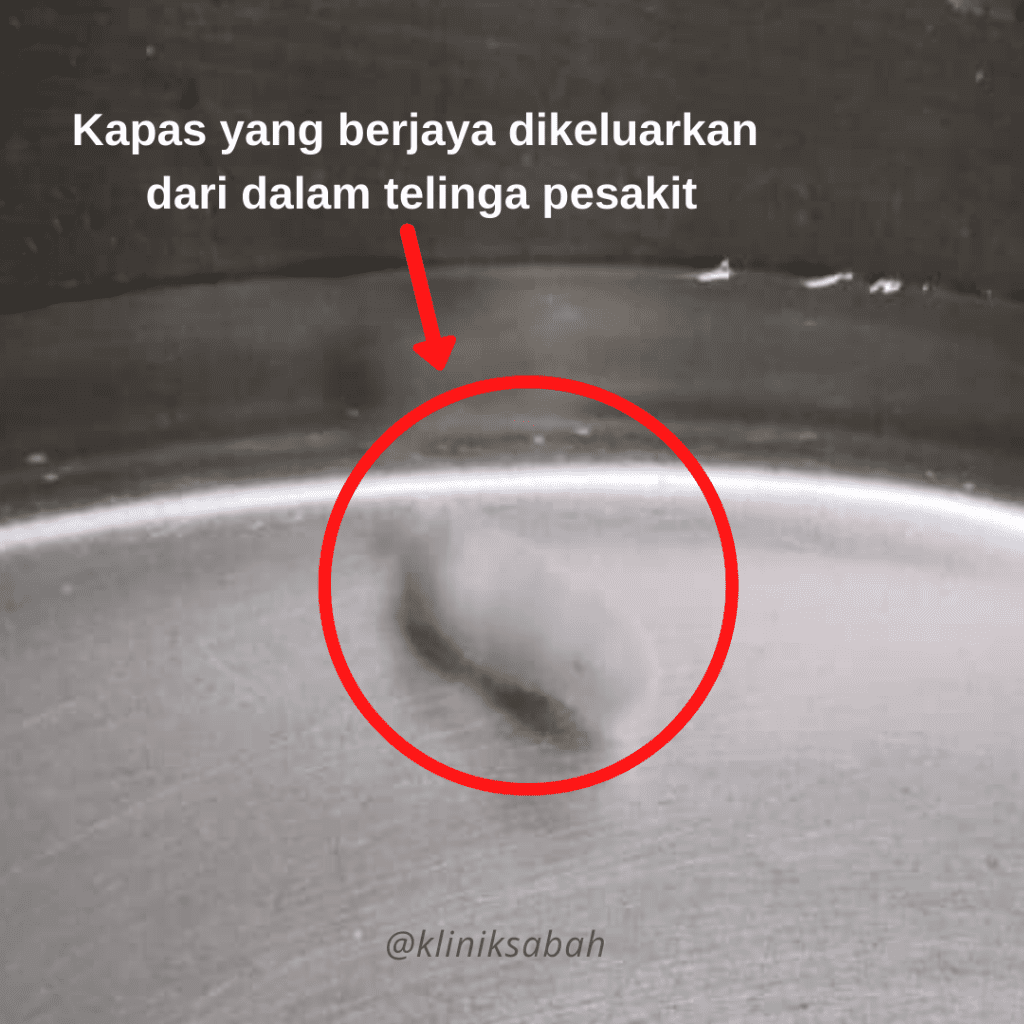 putik kapas yang tertinggal di dalam tel