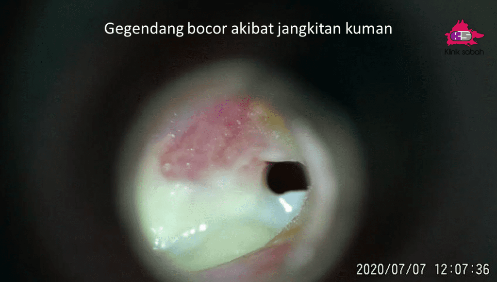 gegendang telinga bocor akibat jangkitan