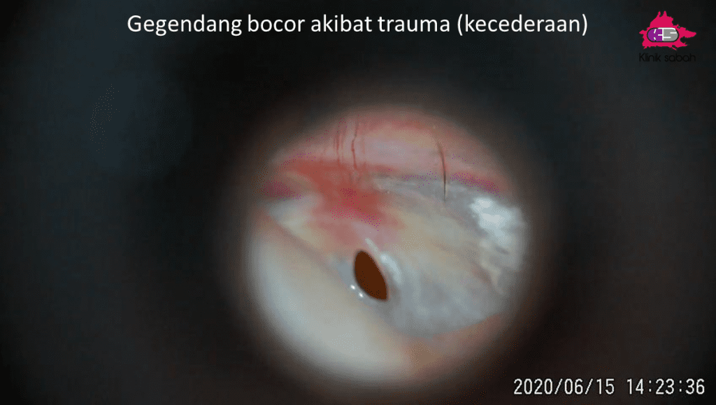 gegendang telinga bocor akibat trauma