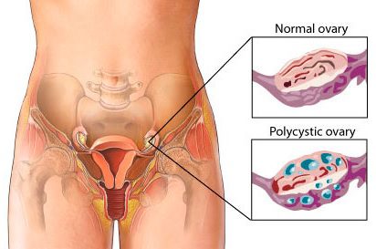PCOS and infertility