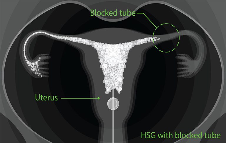 Hysterosalpingogram (HSG) – Mengapa Ia Salah Satu Penyiasatan Penting untuk Ibu yang Sedang Mencuba untuk Hamil (TTC)