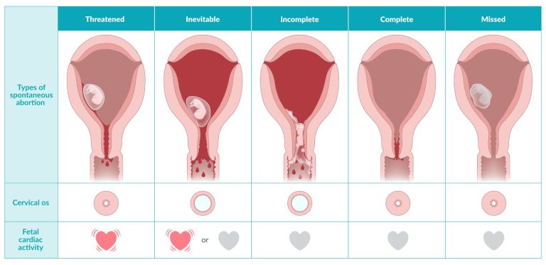 7 Punca Keguguran pada Awal Kehamilan
