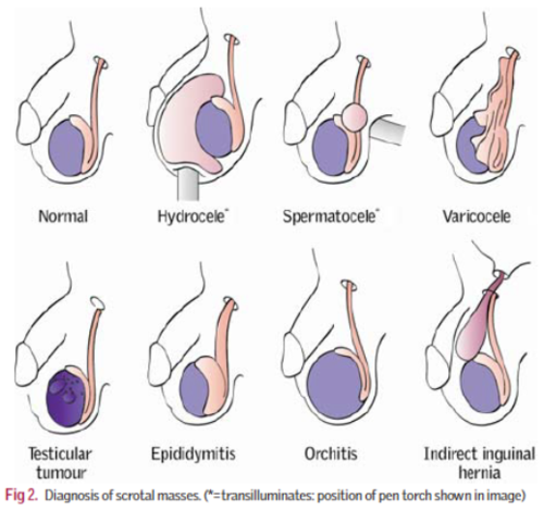 5 Punca Bengkak Buah Zakar Yang Lelaki Kena Jumpa Doktor Segera