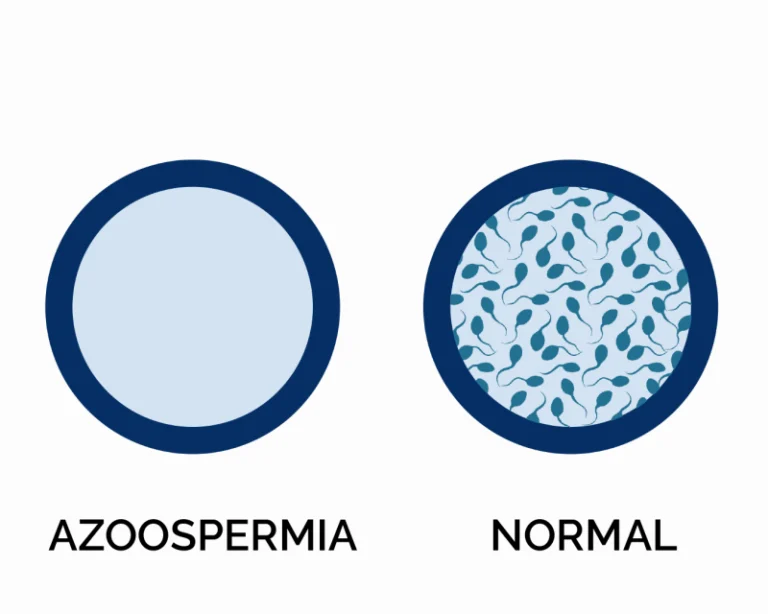 Apa Yang Boleh Kita Lakukan untuk Membantu Lelaki dengan Azoospermia?