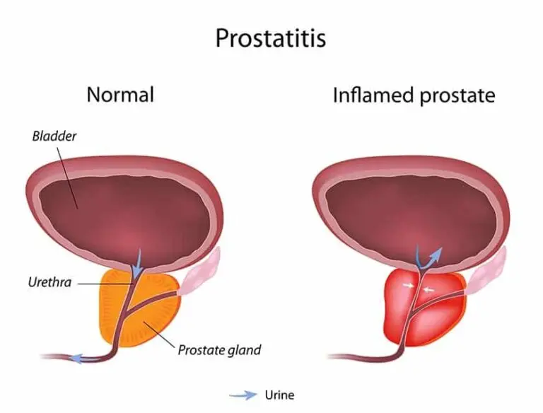 Prostatitis dalam Kalangan Lelaki: Apakah Gejala dan Bagaimana Ia Dirawat?